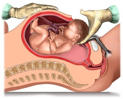 Riesgos del parto por cesárea
