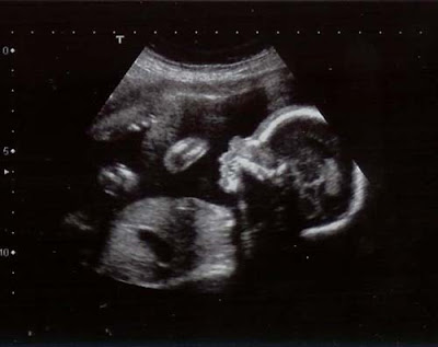 Las ecografías en el embarazo: datos básicos