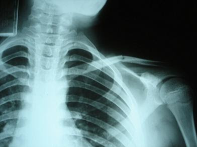 ¿Es seguro hacerse radiografías durante el embarazo?